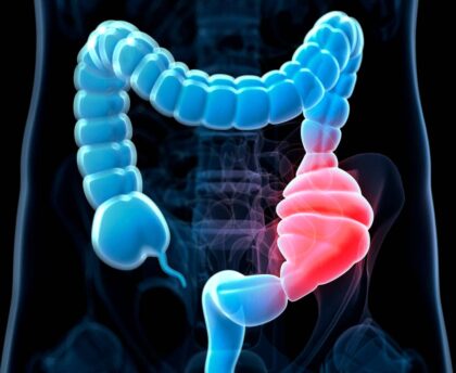 constipated colon diagram