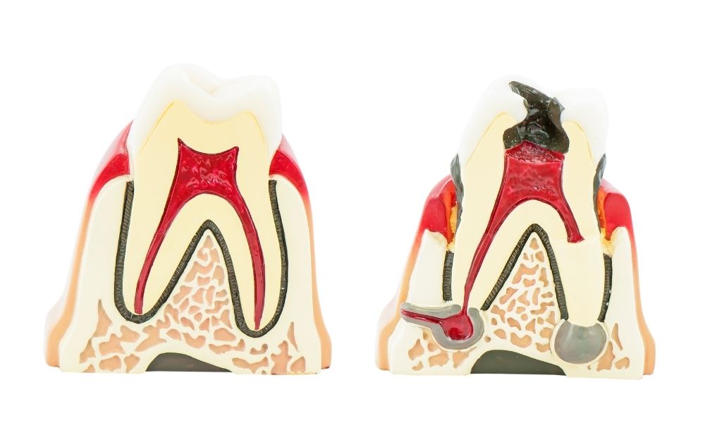 a diagram of a healthy tooth next to a diagram of an infected tooth to show the difference